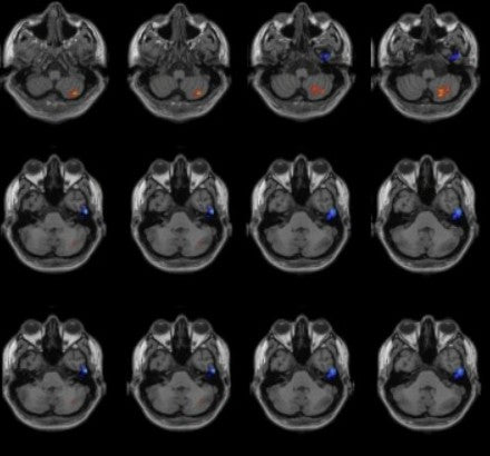 Vagusnerv-Stimulation bei Migräne