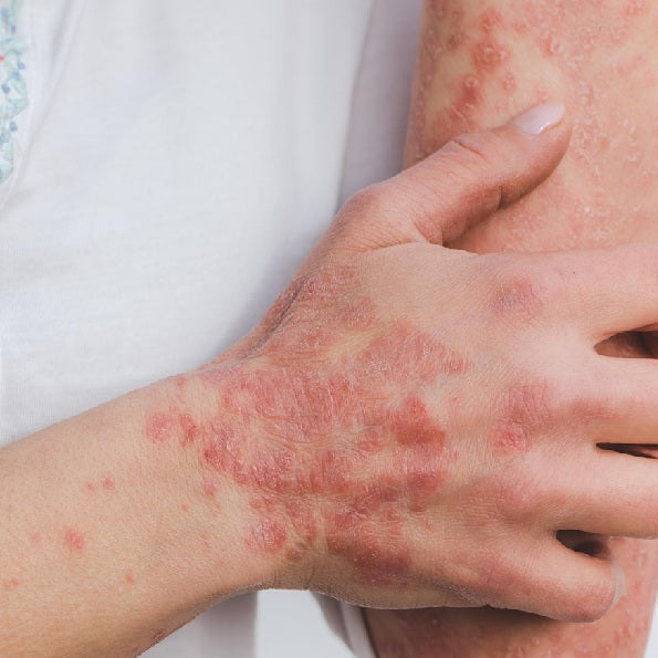 Magnetfeldanwendung bei Neurodermitis, Schuppenflechte